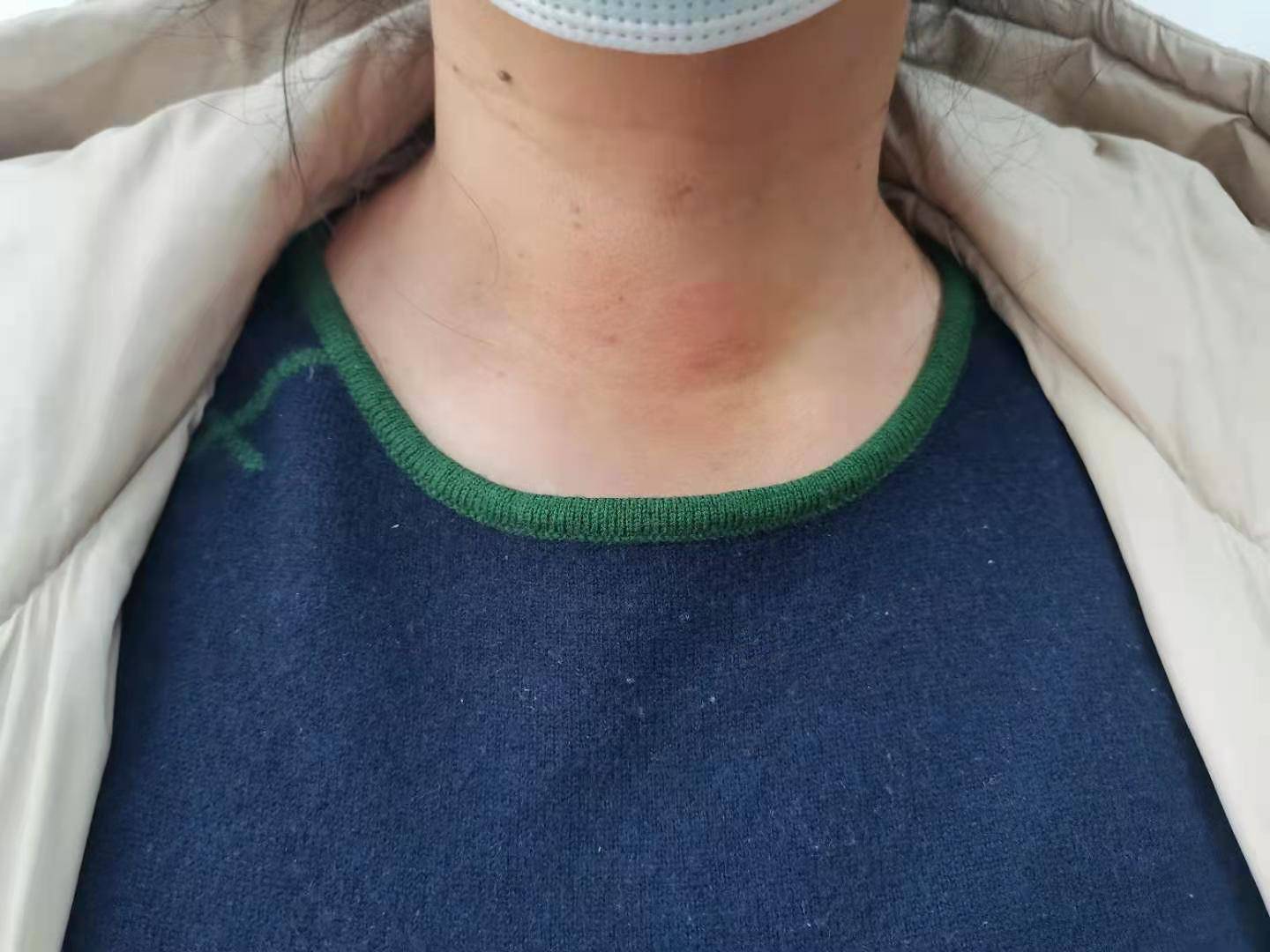 甲状腺结节4级就是癌症了吗