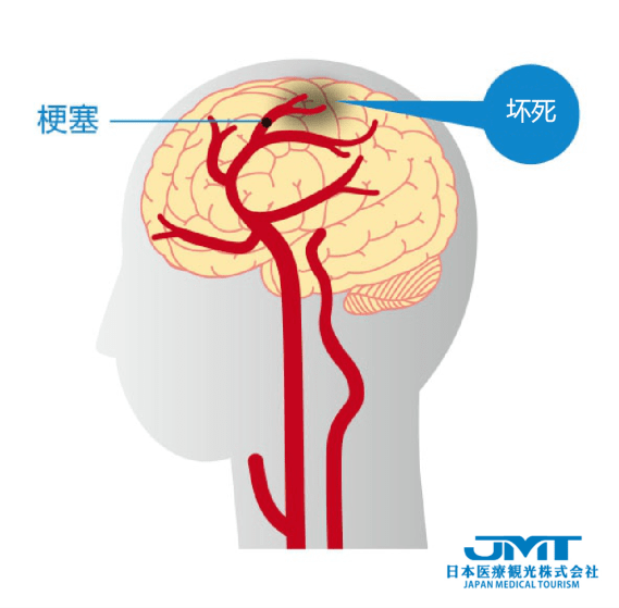 jmt日本医疗中国脑梗塞发病率世界第一脑梗的血管内治疗方式详解