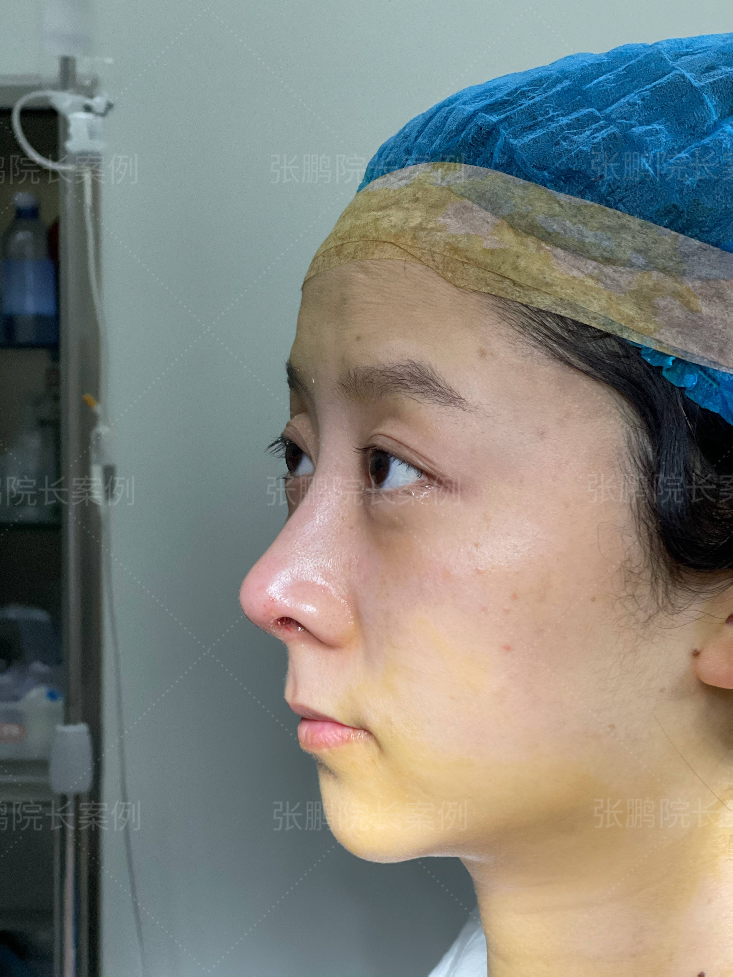 做鼻子多久能够恢复好?张鹏保留鼻