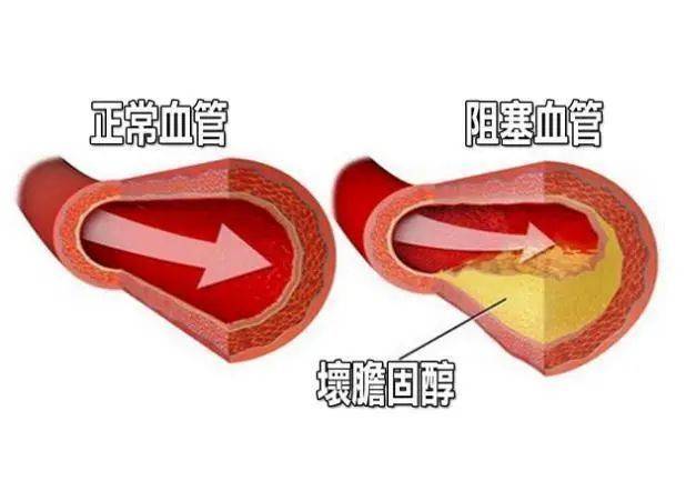 出现这4个症状你的血管可能堵塞了赶快自查