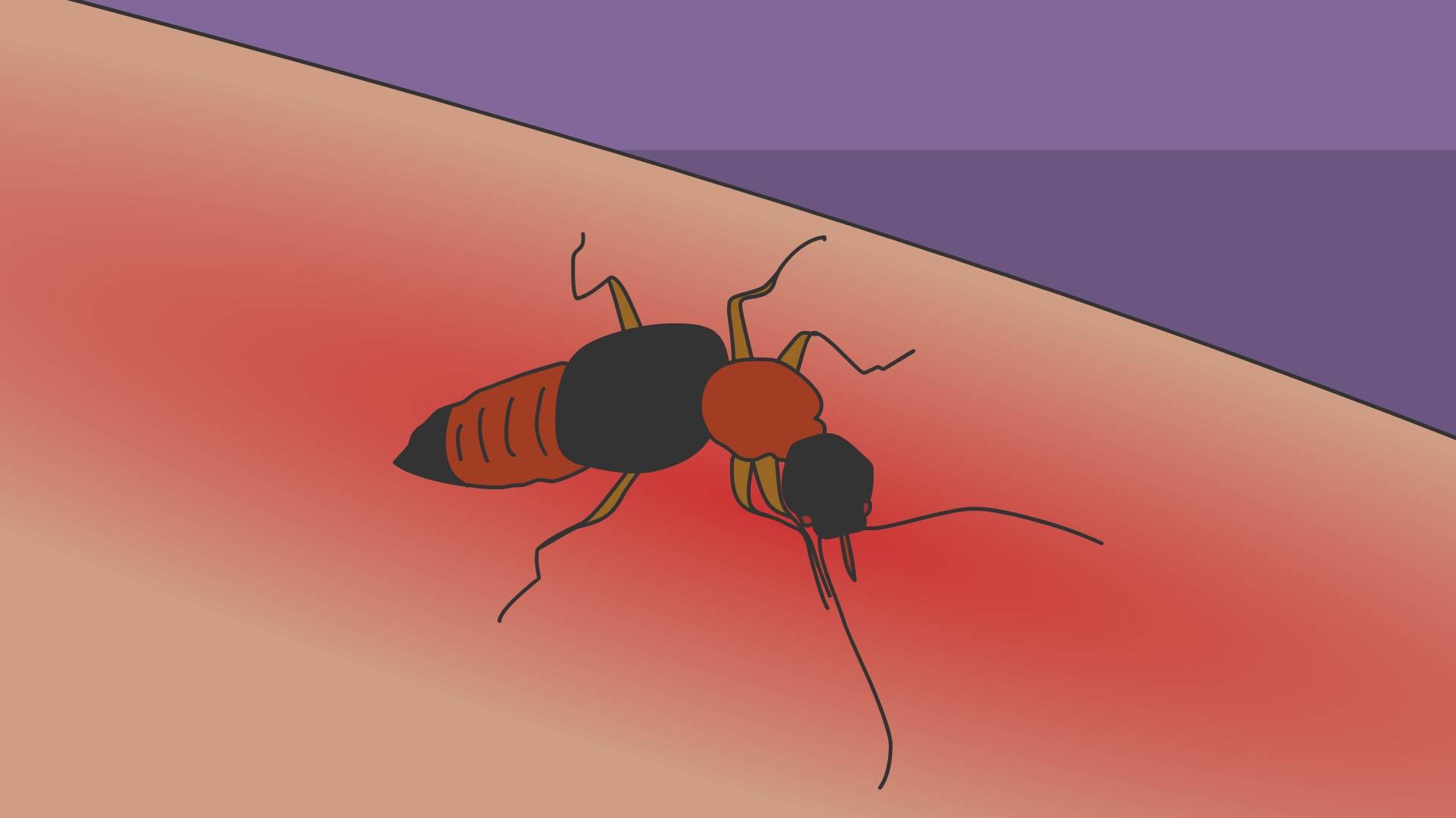 隐翅虫皮炎是怎么引起的?应如何治疗?
