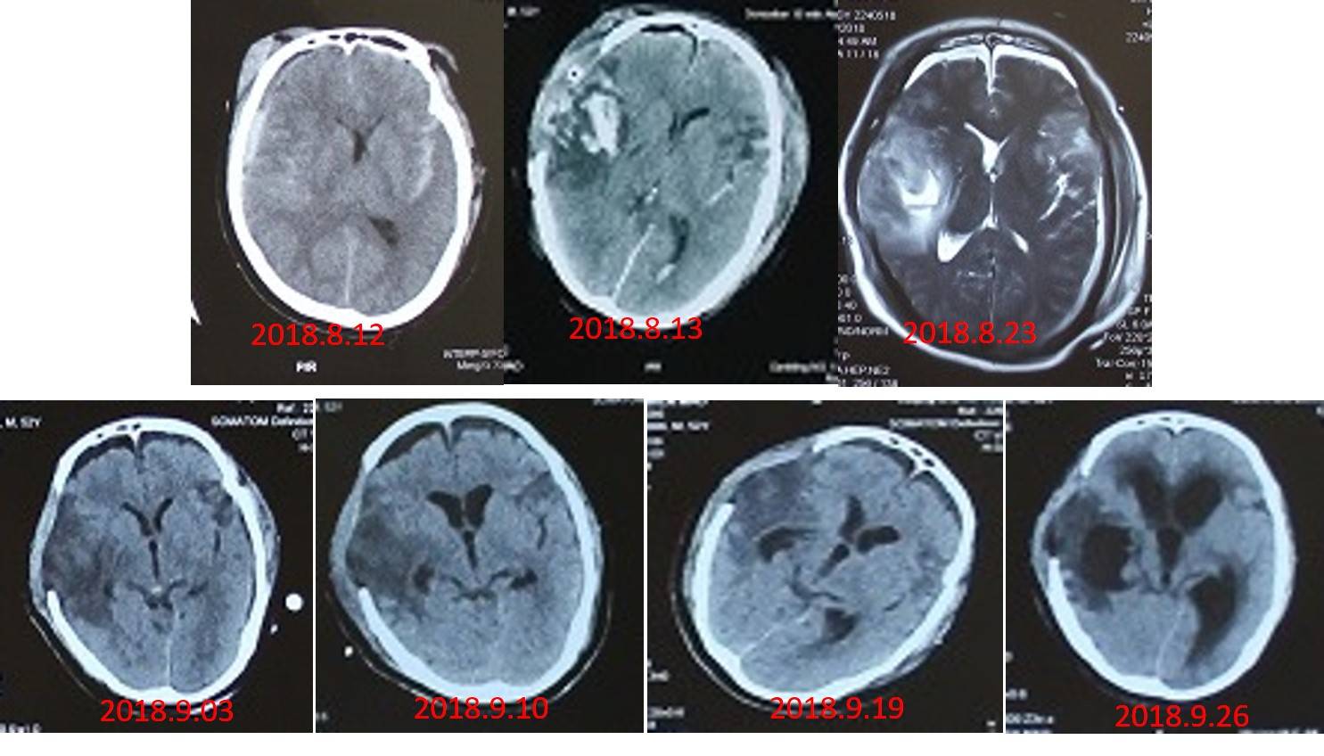 昏迷促醒第二步顱骨修補和腦積水分流