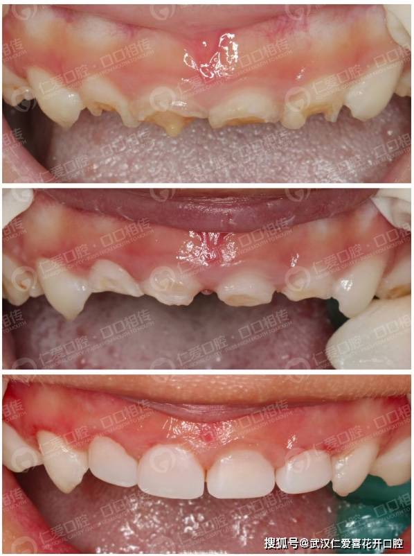 儿童牙齿涂氟前后图片图片