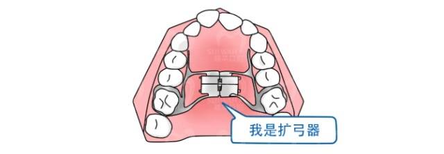 牙齿矫正中的扩弓器,是用来做什么的?