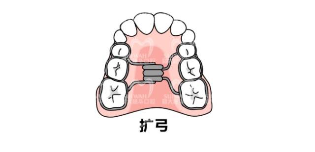 牙齿矫正中的扩弓器,是用来做什么的?