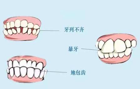 轮廓|圣嘉新邱立东：带牙套对改脸型手术有影响吗？