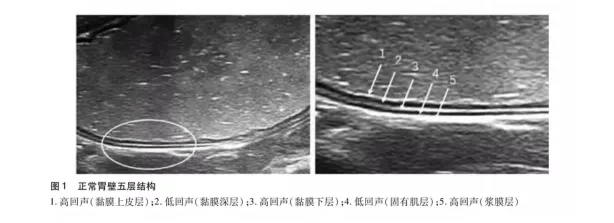 造影剂|胃肠也能做B超？专家：有其特有优势，适合七大类情况