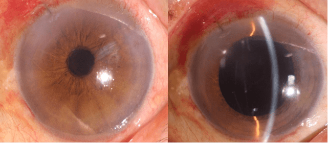 白内障手术后没装人工晶体还能再装吗