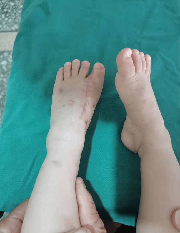 诊疗范围包括:各种类型断指,断肢,多肢离断的再植,各种类型皮瓣移植