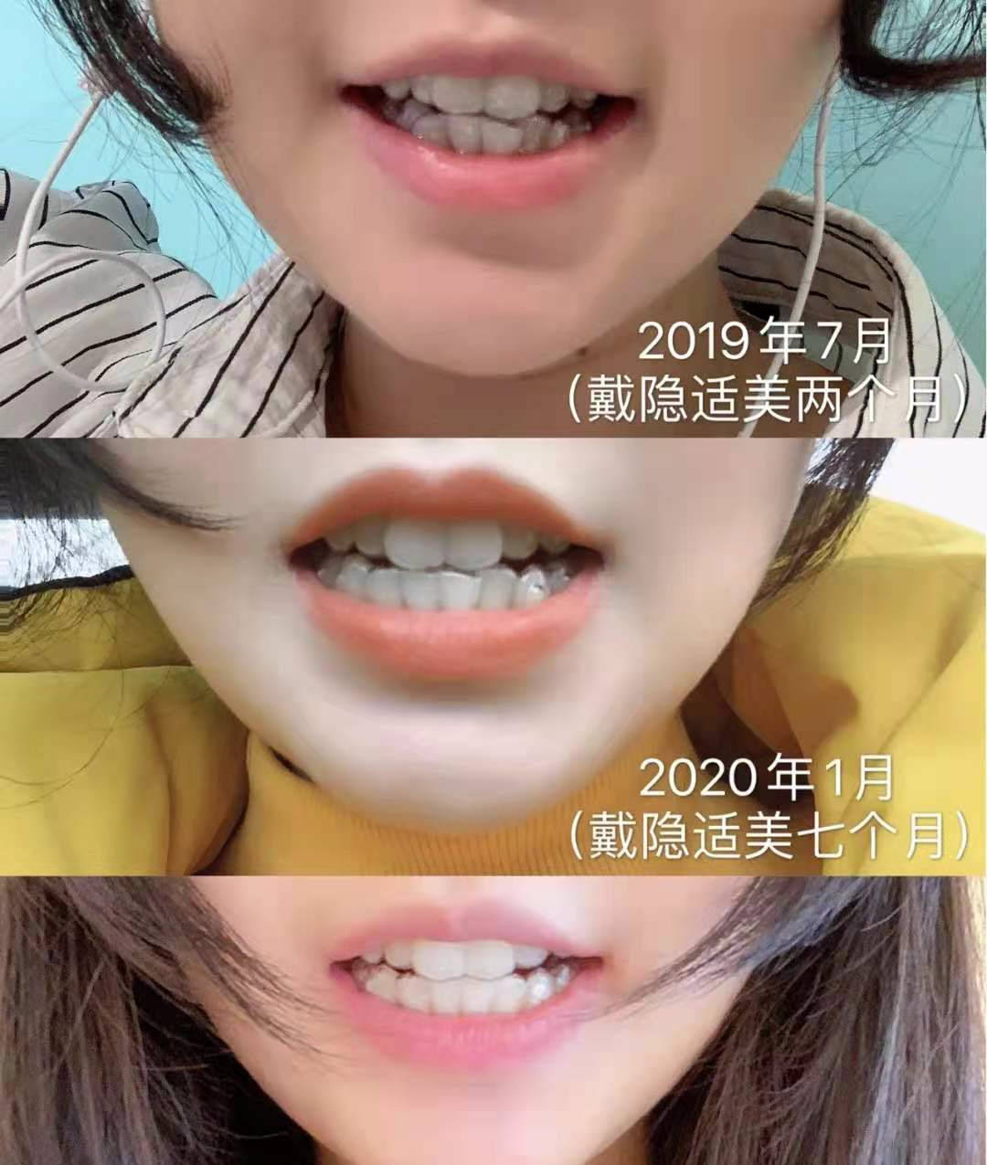 隐形牙套1~12月变化图图片