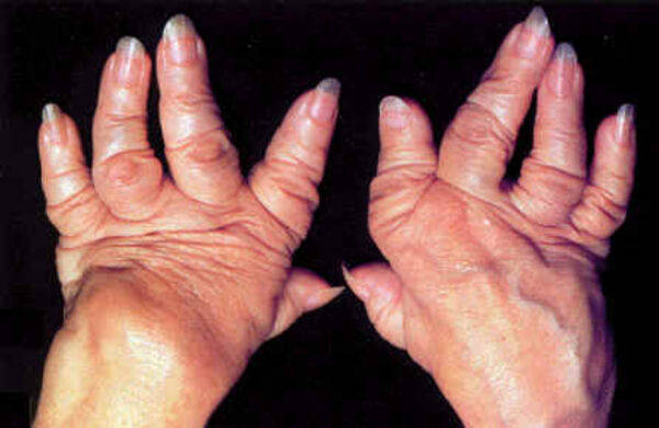 干细胞让类风湿患者摆脱痛苦