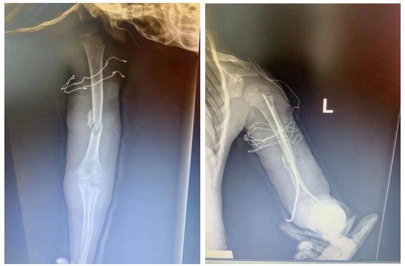 儿童创伤小,避免了手术切开复位所导致的风险及手术取钢板的二次创伤