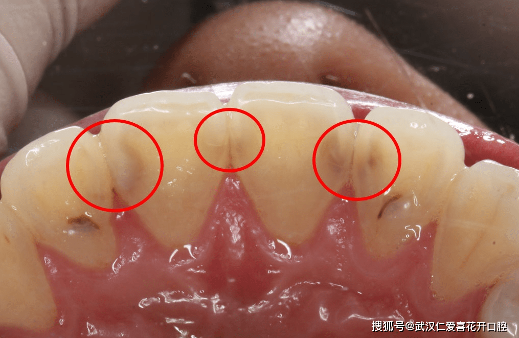 武汉仁爱口腔牙齿龋坏蛀牙的样子以及处理方法