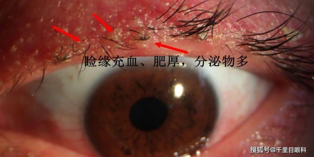 别说你不知道螨虫能导致失明