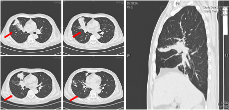 灌注|全身+局部 介入+灌注，清华长庚呼吸科治愈顽疾“肺毛霉菌病”