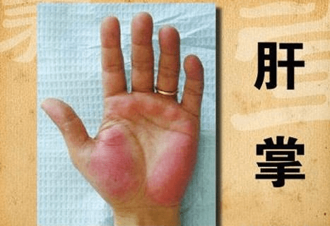 毒素|肝病多是“拖”出来的,身体出现“2臭2红”,莫忽视,是肝在”呼救“