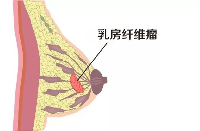 乳腺纤维瘤会影响哺乳吗