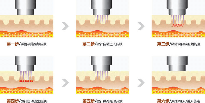 治疗|极塑波属于面部射频超声同步抗衰美容仪器吗？