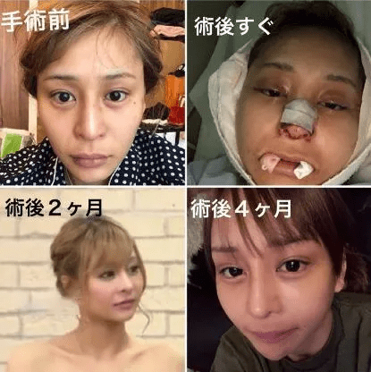 日本妹子因长相酷似大猩猩,10年整形100次只为整成石原里美_樱井