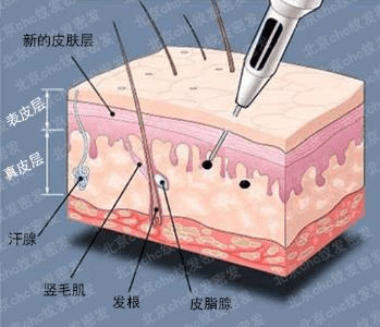 永久黑米3D纹发：纹发能保持多久？为什么不是永久的？