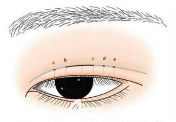 因为|楼善叶全切双眼皮修复及术后注意事项