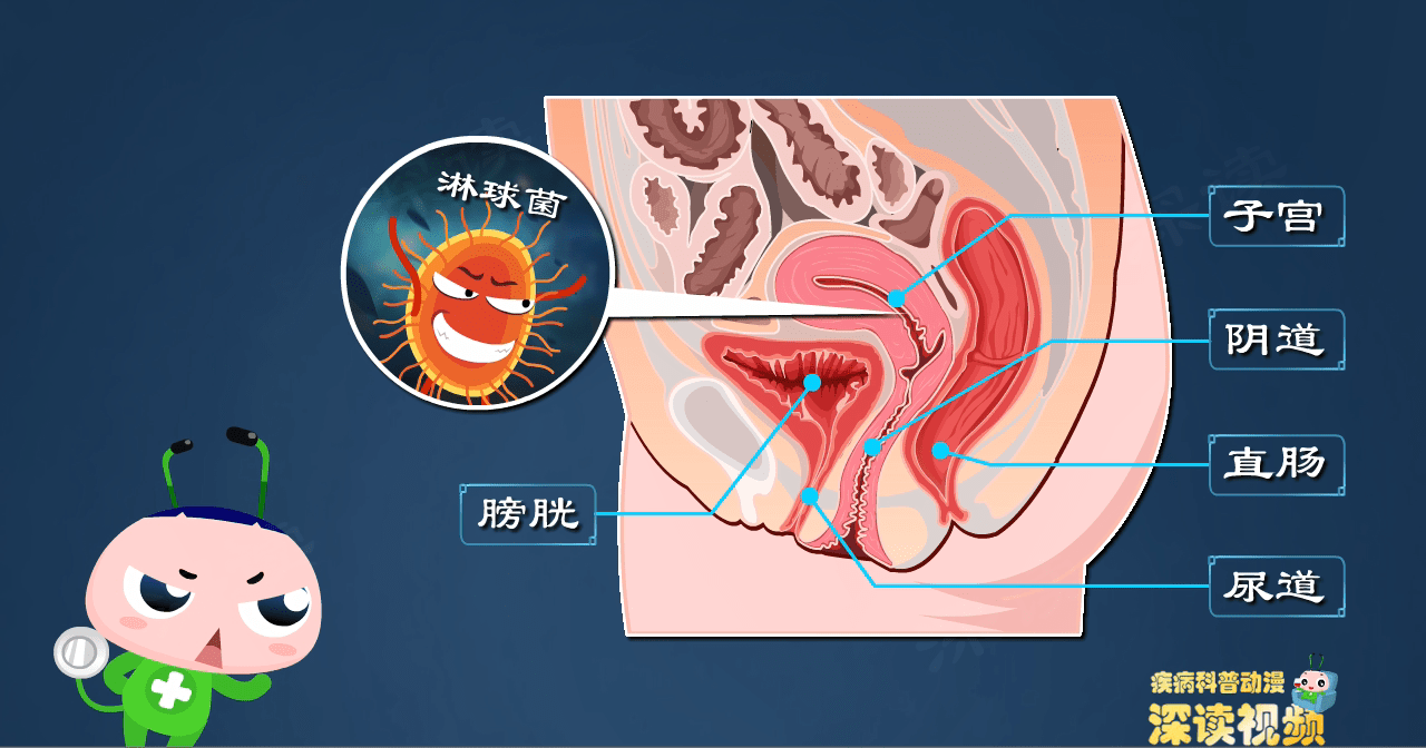 原创全球每年约20万妇女得淋病19禁淋病知识都在这小清新慎入