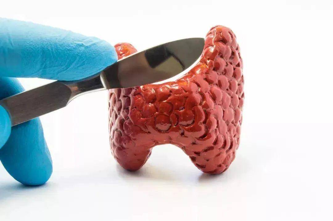 生活|甲状腺结节会自愈吗？ 王克珍专家：尽量远离这3物, 结节会慢慢变小！