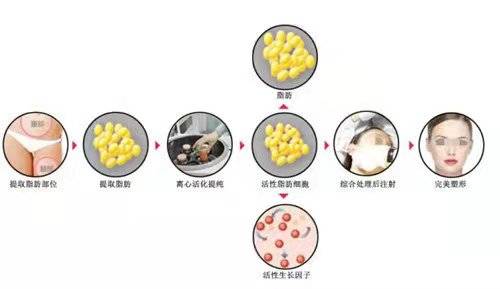 下巴瞧了脂肪填充图片, 看完自体脂肪下巴填充图片太疯狂了~