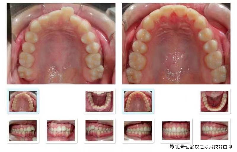 過程 這是戴隱適美矯正過程中的效果,可以明顯看出個別牙齒反合已解除