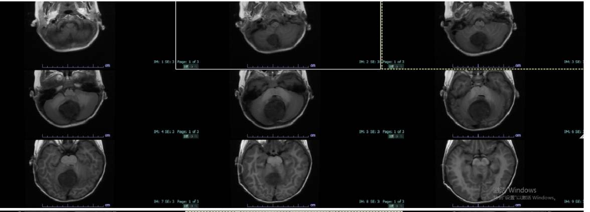 小儿|郑大三附院小儿神经外科成功完成河南首例脑干恶性肿瘤切除术