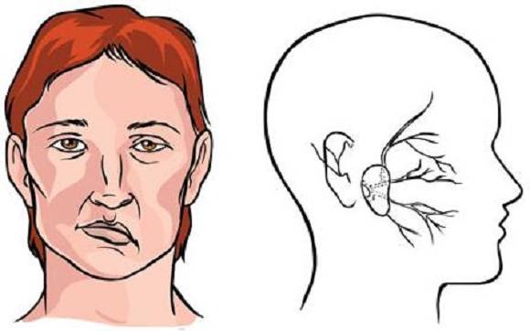 局部|低频电刺激对于面神经麻痹可以有什么效果？