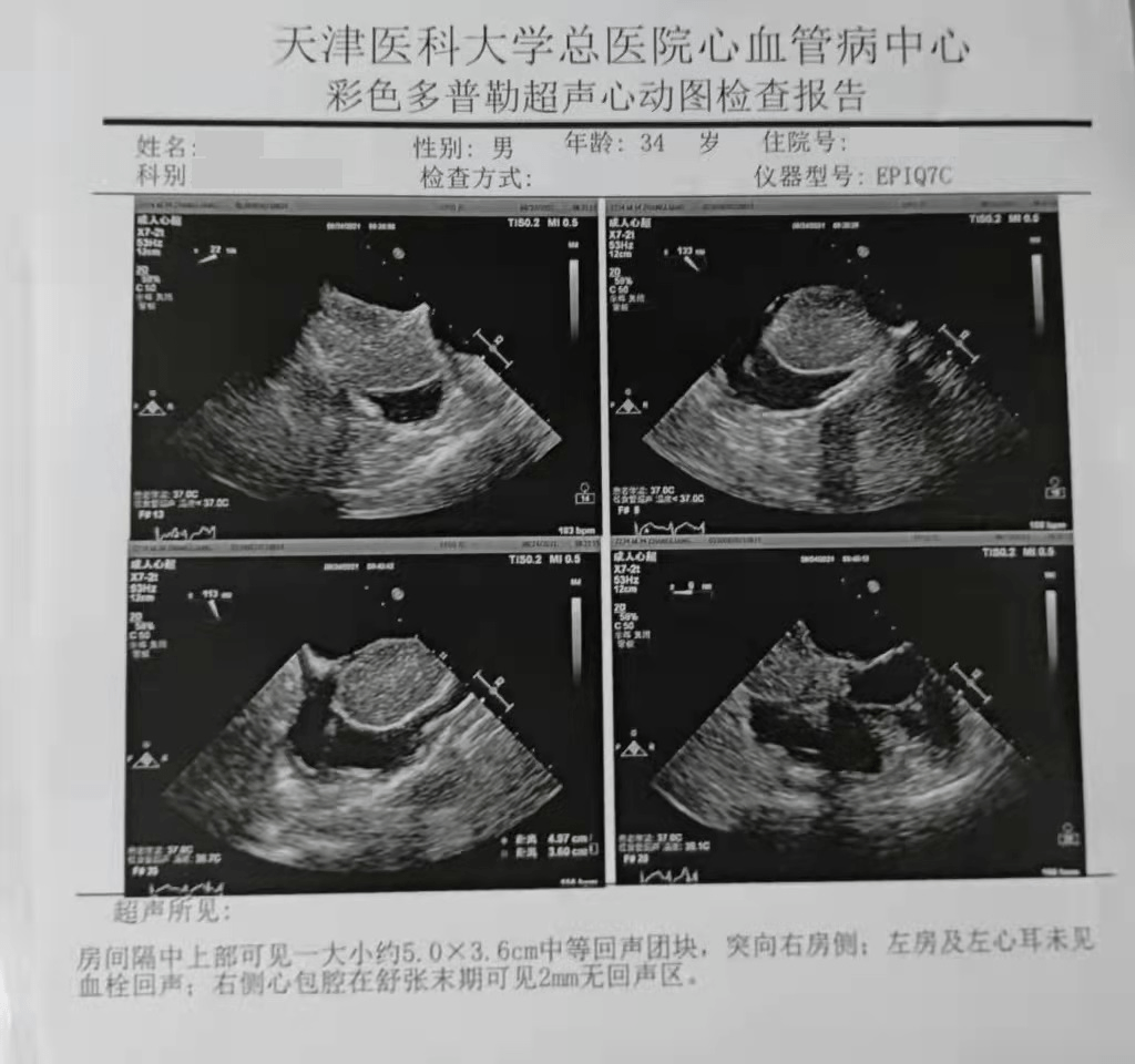 赵冬|发病率百万分之一！天津专家在男子心脏里取出乒乓球大小肿瘤！