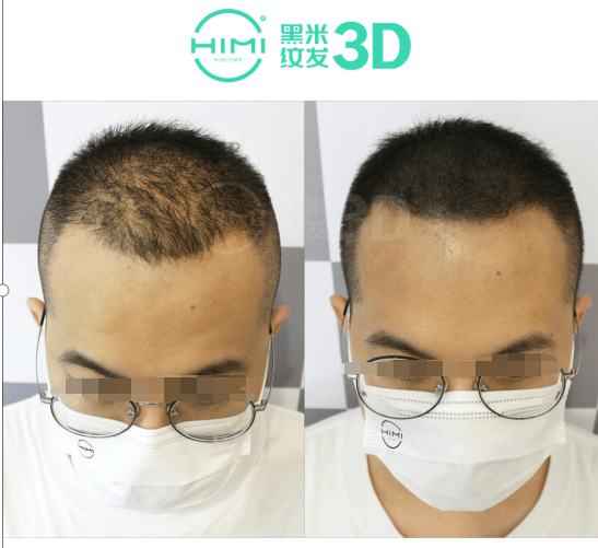 头皮黑米3D纹发：纹发的疼痛感怎么样？能忍受吗？