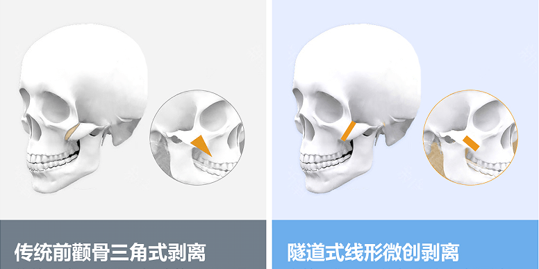 高会张笑天：做颧骨内推推越多效果越好？并不是！