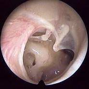 潍坊耳鼻喉专家介绍为什么有的孩子会出现鼓膜穿孔症状?