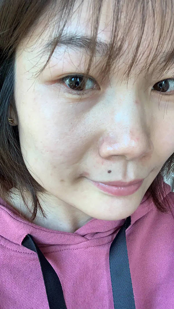 柠檬秦书雅的脸祛痘是真的吗，秦书雅的脸真的如说的那么好吗？