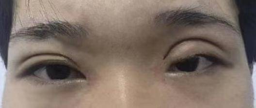 割双眼皮是"微整"小手术?这9大双眼皮失败表现,你有必要知道_进行