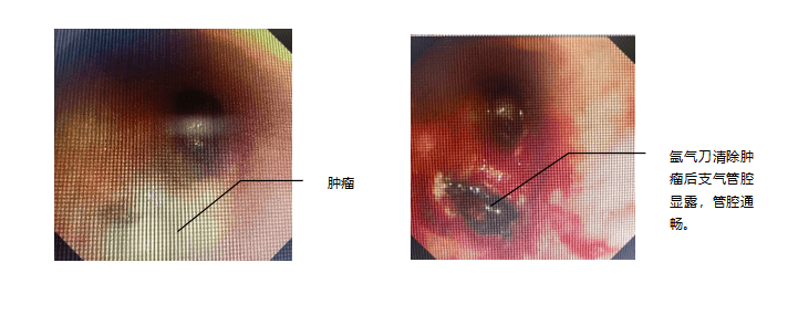 步伐|西安交大一附院东院区呼吸内科团队紧跟融合发展步伐 开展多项先进医疗技术