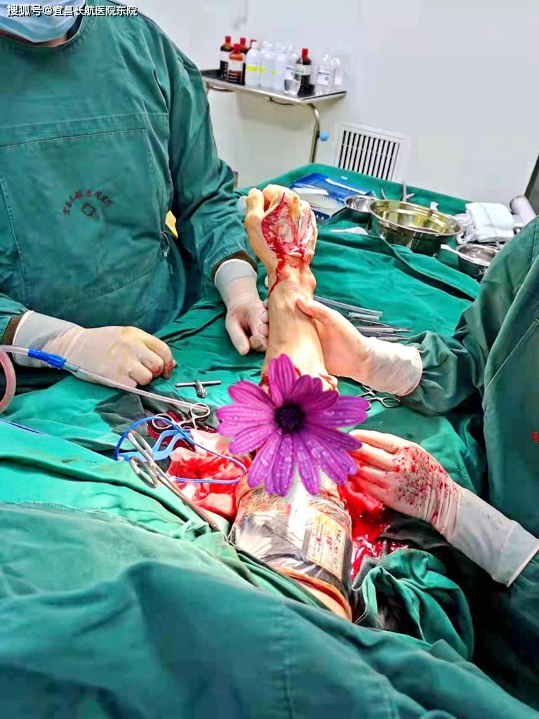 长航东院骨科:断肢再接难度大,东院专家敢挑战