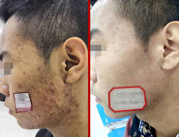 方法痘痘千万别乱挤，找对方法，祛痘很简单的