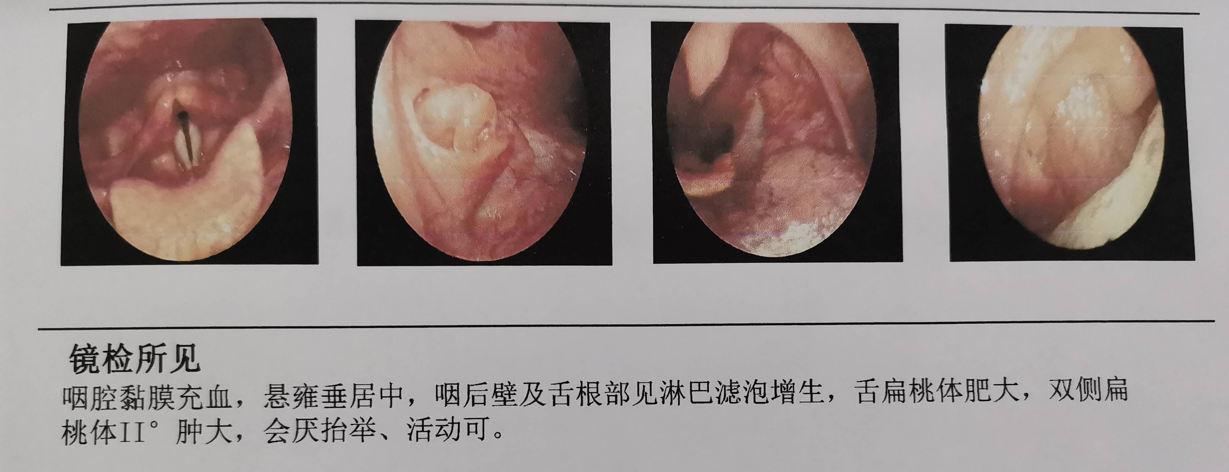 舌扁桃体肥大; 3 慢性咽炎; 4 茎突过长(双侧)