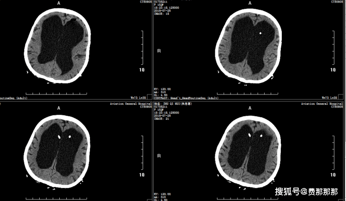 血块|“大头娃娃”艰难求医路----------一例特殊的先天性脑积水补救性治疗