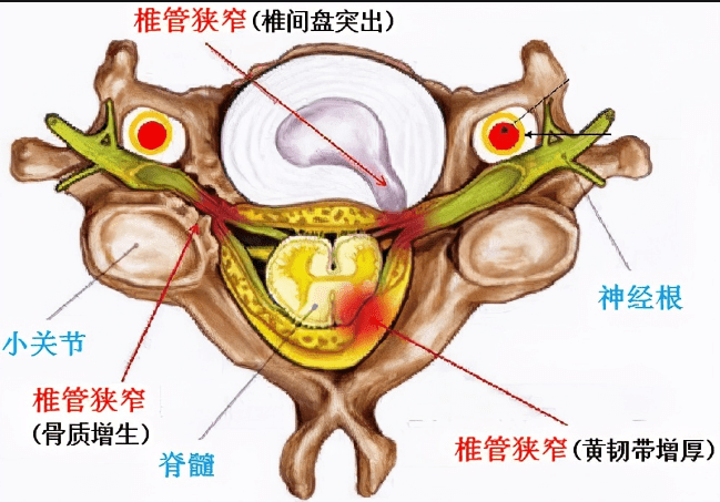 腰椎隐窝位置示意图图片