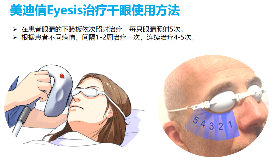 整个操作下来2分钟不到,就能把睑板腺里面的油脂完全化开,效