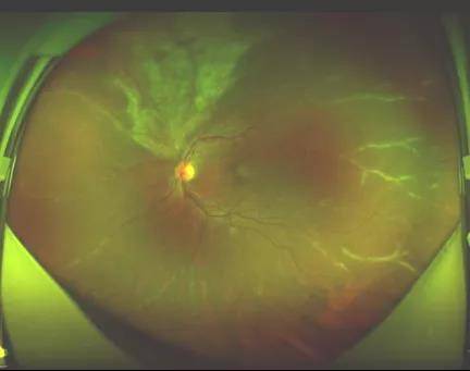 王海燕|莫要谈“艾”色变，关注艾滋患者的眼健康