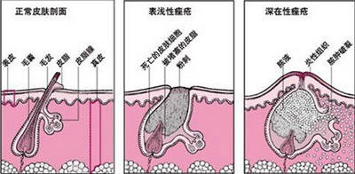 怎么杀死脸部痤疮杆菌 1128586bd9654670b4c1cc54717bee07.jpeg