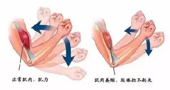 神经系统|为何小脑萎缩共济失调会出现肌肉萎缩?