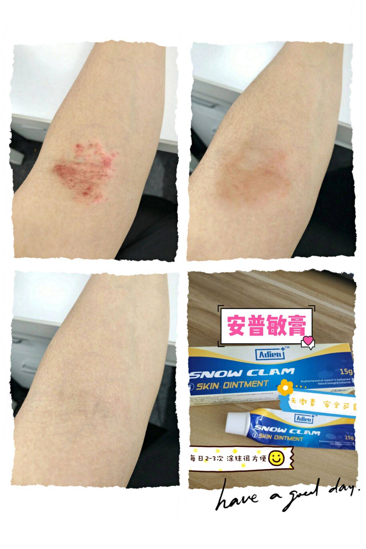 湿疹里干燥的皮肤是怎么回事 干性 症状 红薯 湿疹里干燥的皮肤是怎么回事 干性 症状 红薯