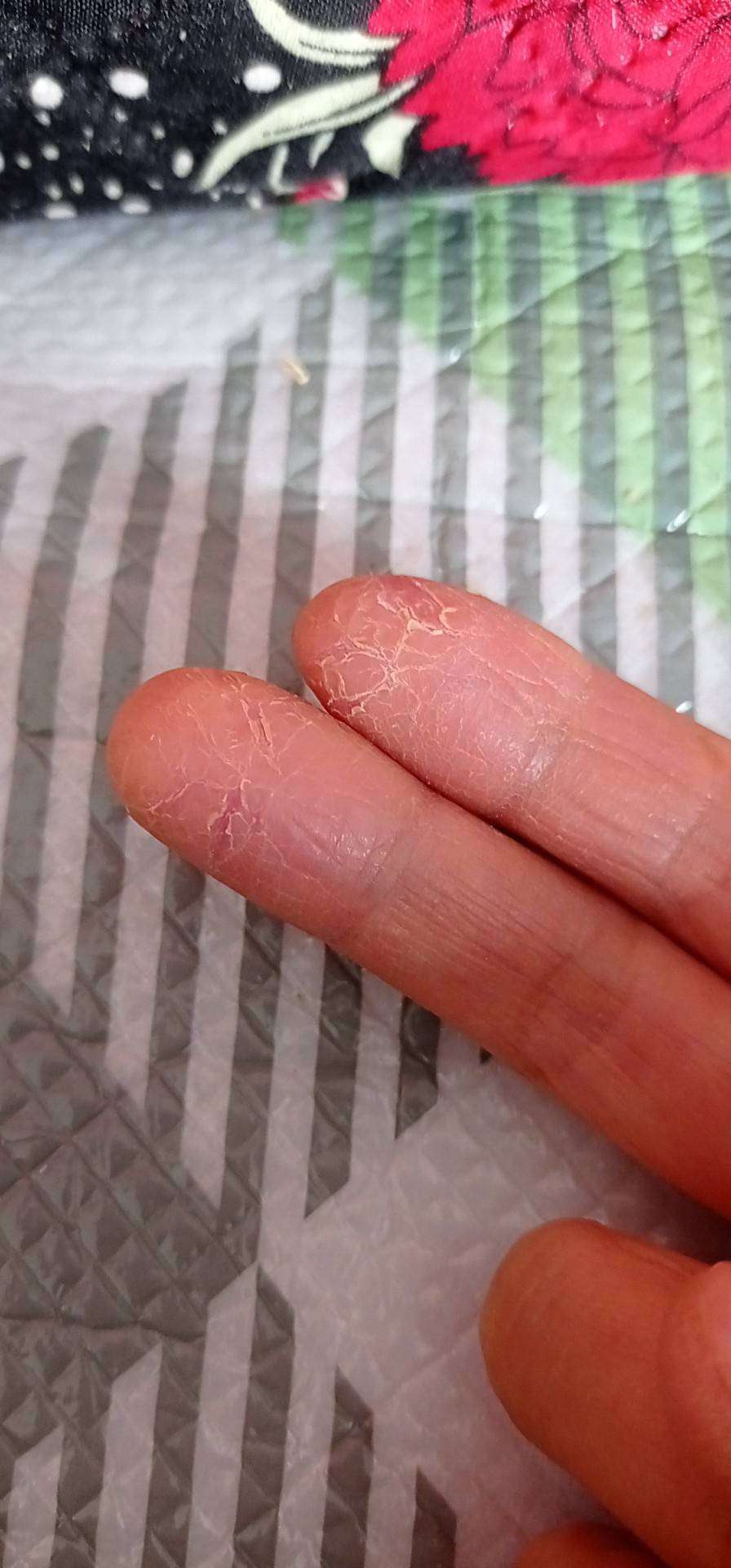 手指起皮是怎么回事图片