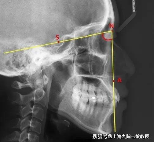 九院韦敏教授丨直面型、凹面型与凸面型有何区别,可能看这2个方面_进行_面部_问题
